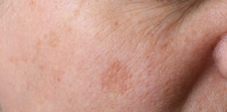 Hoe kun je pigmentvlekken bedekken? pigmentvlekken